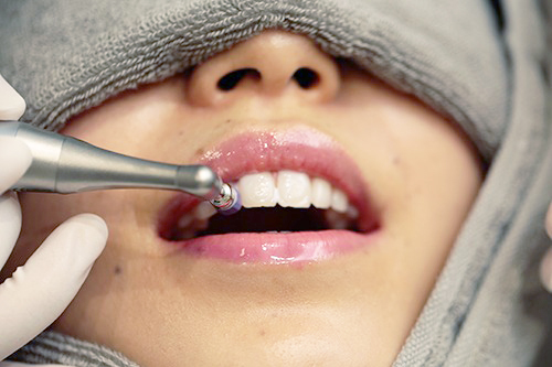 歯の表面の清掃