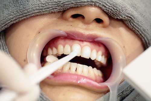 ホワイトニング剤塗布