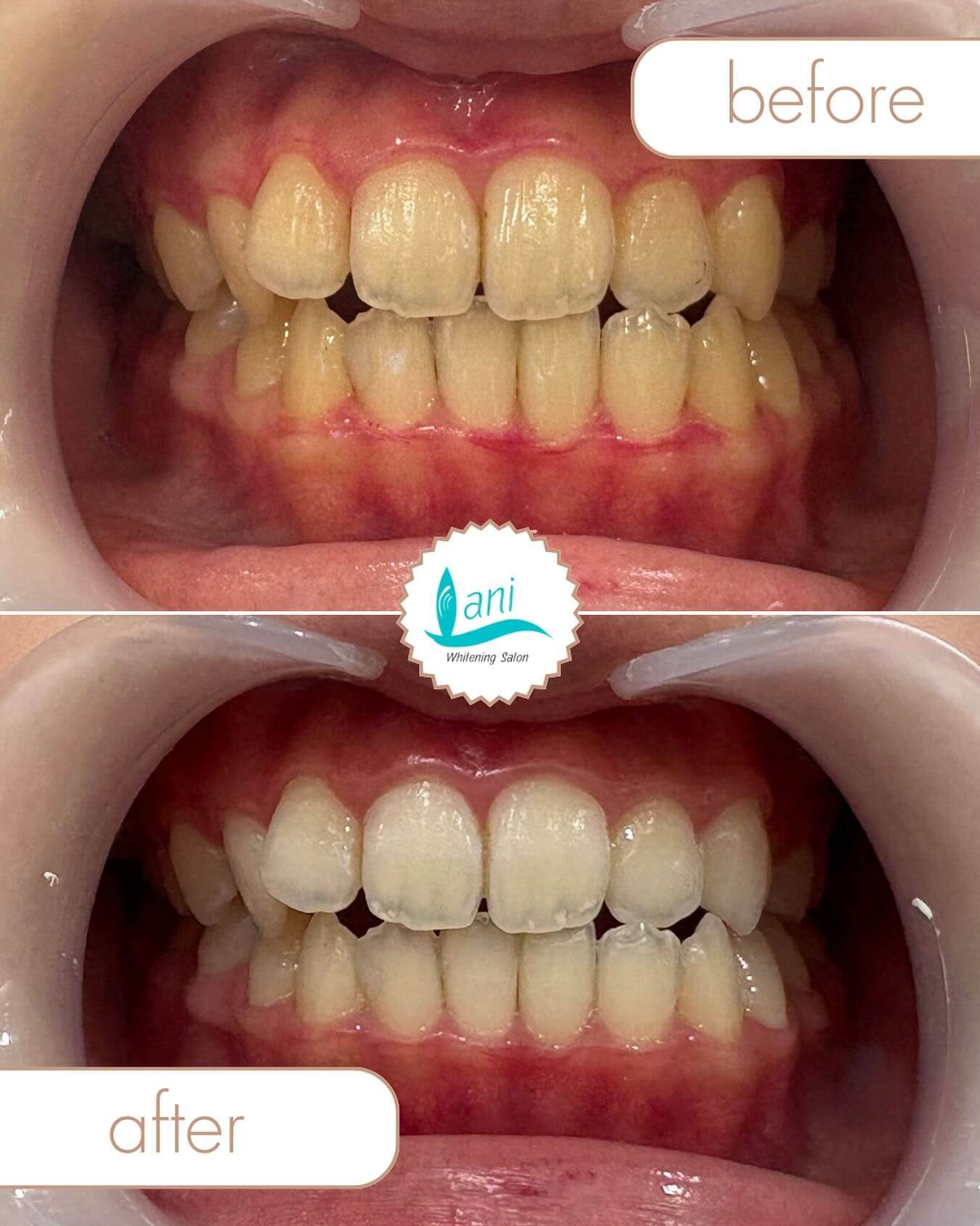 ホワイトニング Before → After