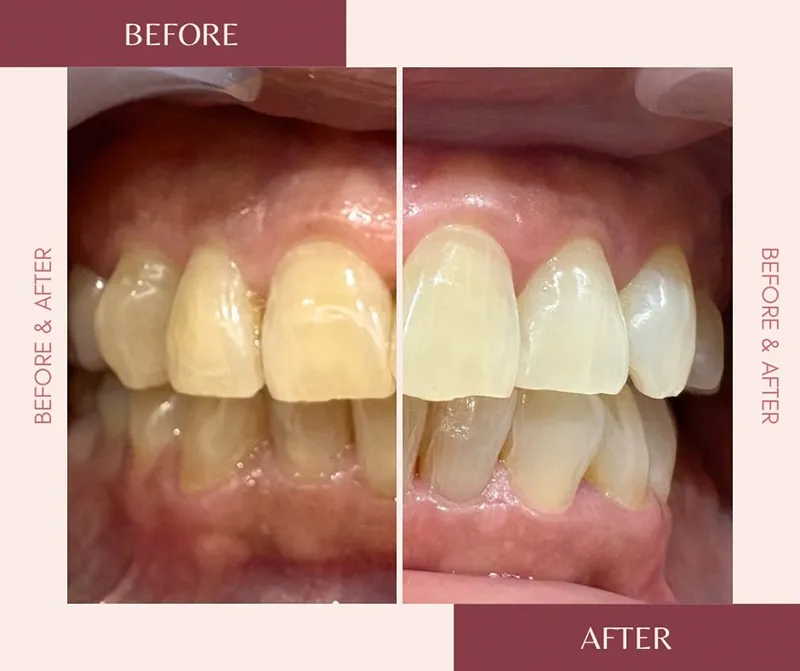 【Before → After】30代　2ヶ月コース
